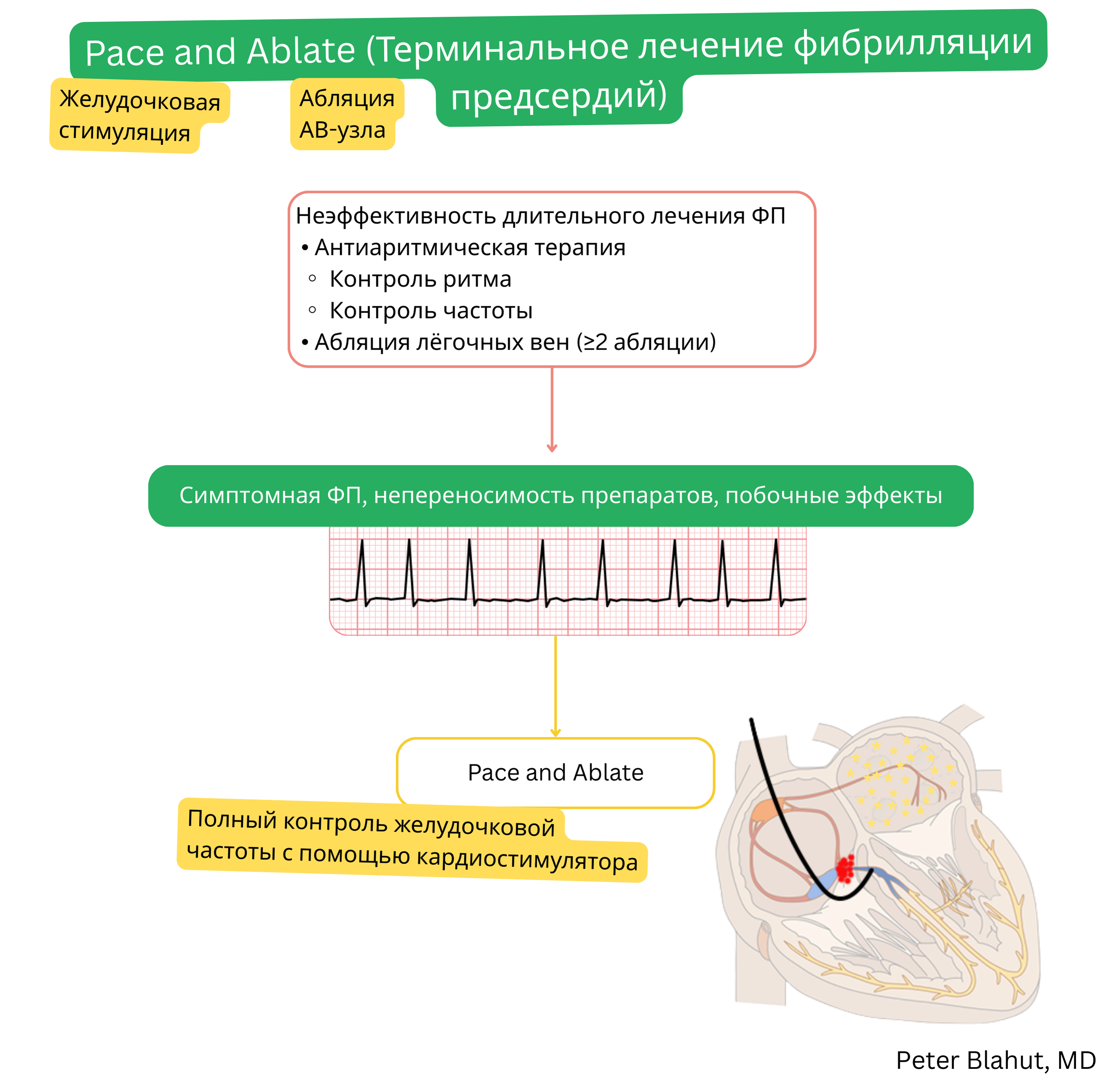 Схема стратегии pace and ablate при терминальном лечении фибрилляции предсердий после неэффективности антиаритмической терапии и повторных аблаций, включающая аблацию АВ-узла с последующей постоянной желудочковой стимуляцией для полного контроля частоты.