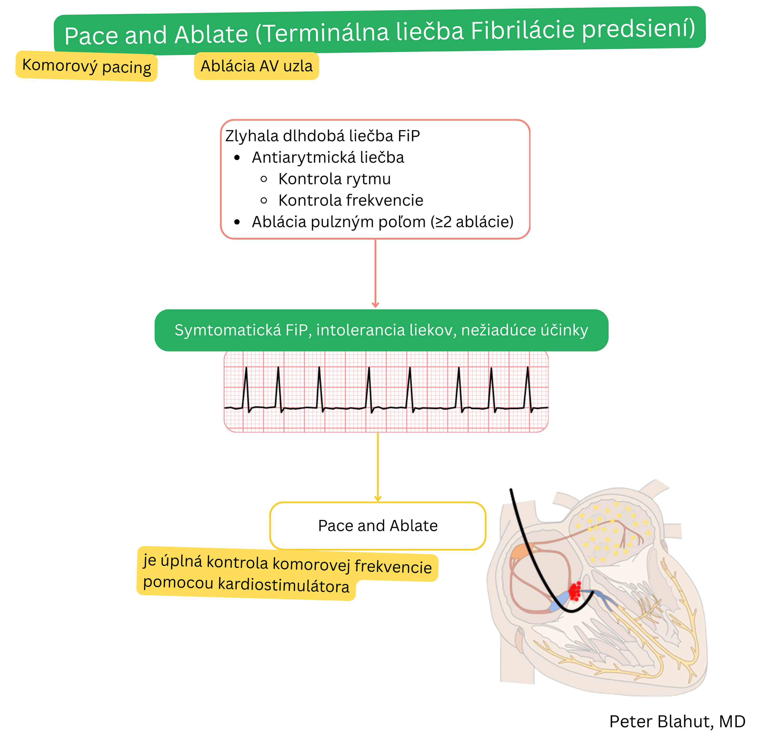 Schéma stratégie „pace and ablate“ pri terminálnej liečbe fibrilácie predsiení s indikáciou pri zlyhaní antiarytmickej liečby a opakovaných abláciách, zahŕňajúca abláciu AV uzla a následnú trvalú komorovú stimuláciu na dosiahnutie úplnej kontroly komorovej frekvencie.